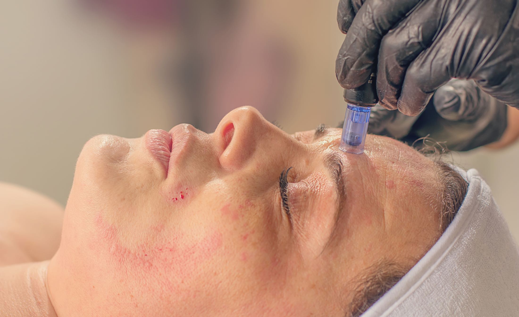 Understanding PRP Therapy: The Science Behind the 'Vampire Facial'